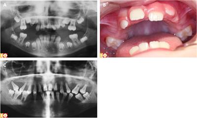 Primary Immunodeficiencies With Defects in Innate Immunity: Focus on Orofacial Manifestations